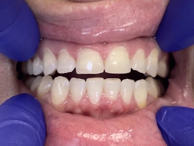 Esthetic Crown Lengthening Before