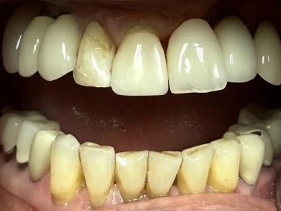 Single tooth bonding after