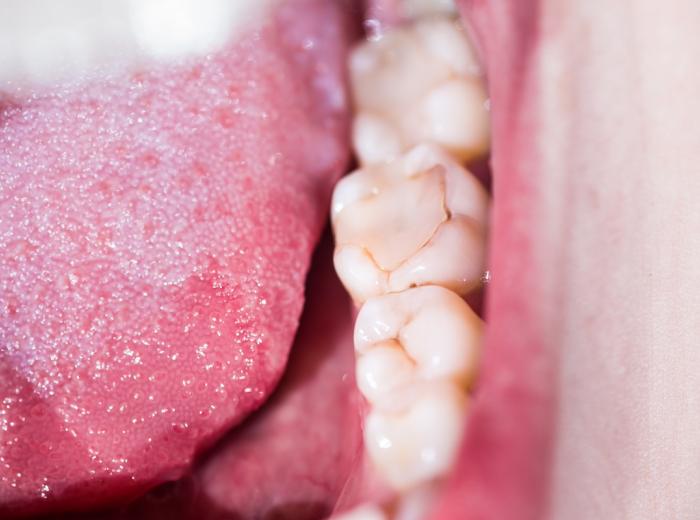 3 Signs that Your Dental Filling Is Going Bad